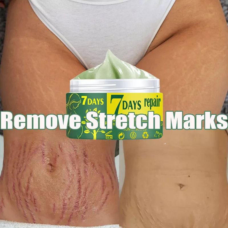 Stretch marks removal
