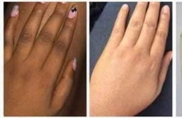 Knuckles Dark Spot Remover