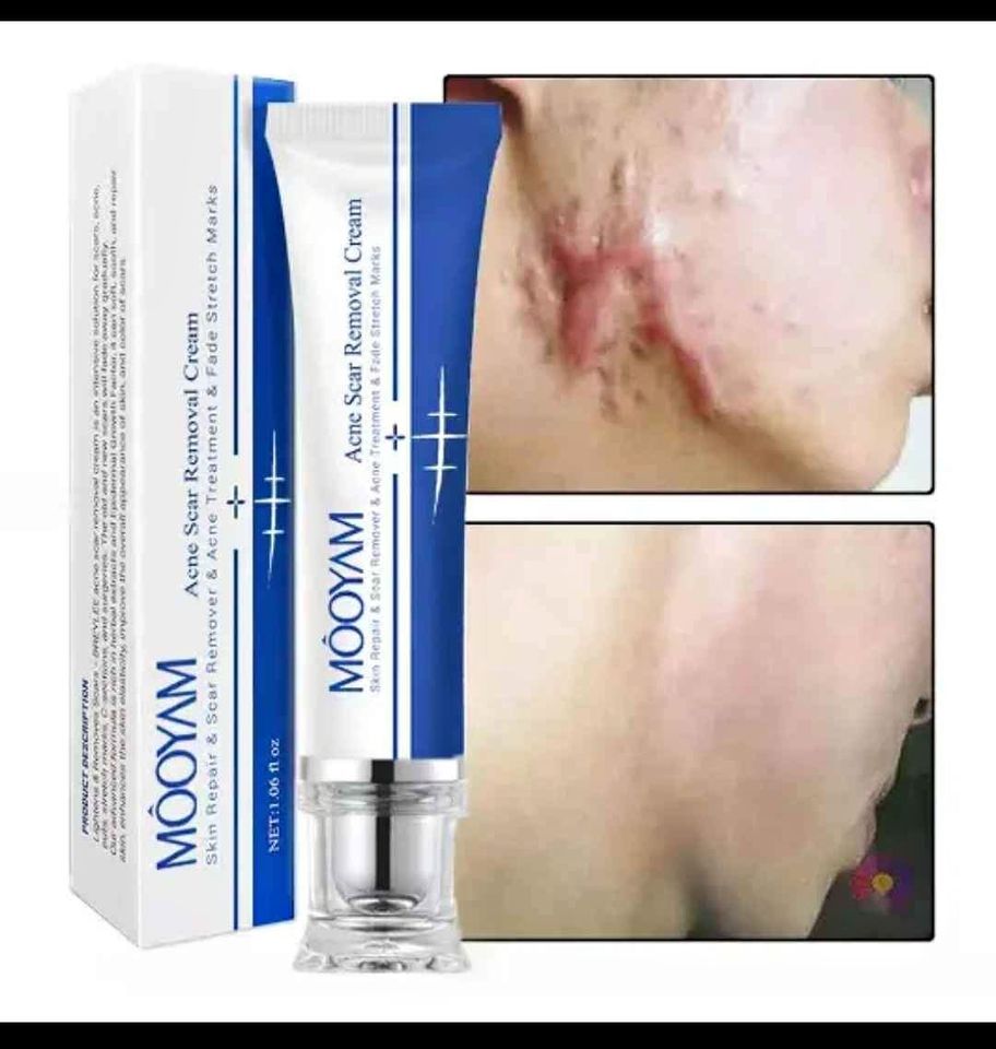 Scar Removal Cream