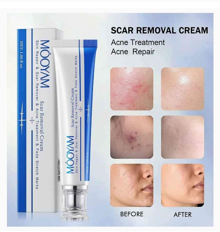 Scar Removal Cream_1
