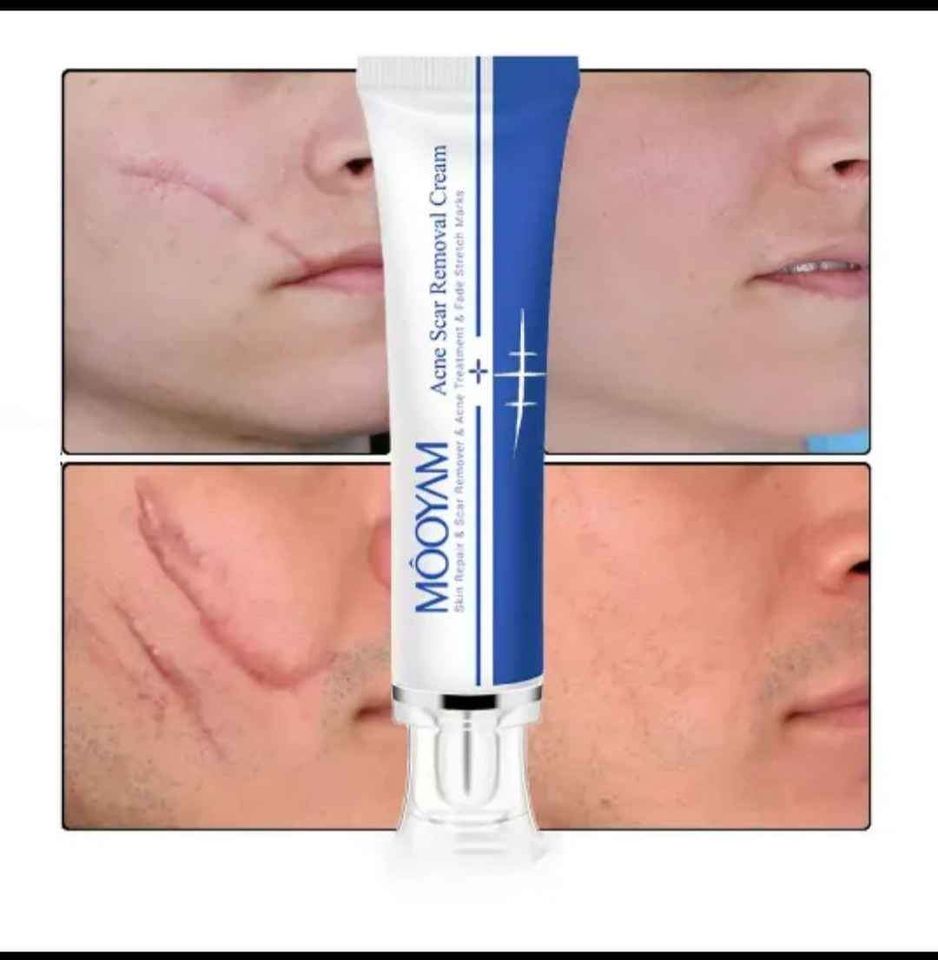 Scar Removal Cream_6