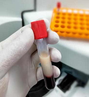 Lipid Profile فحص نسبة الدهن