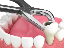 Tooth Removal / Extraction (Excluding Wisdom Teeth)_0