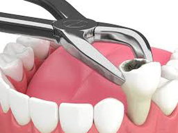 Tooth Removal / Extraction (Excluding Wisdom Teeth)