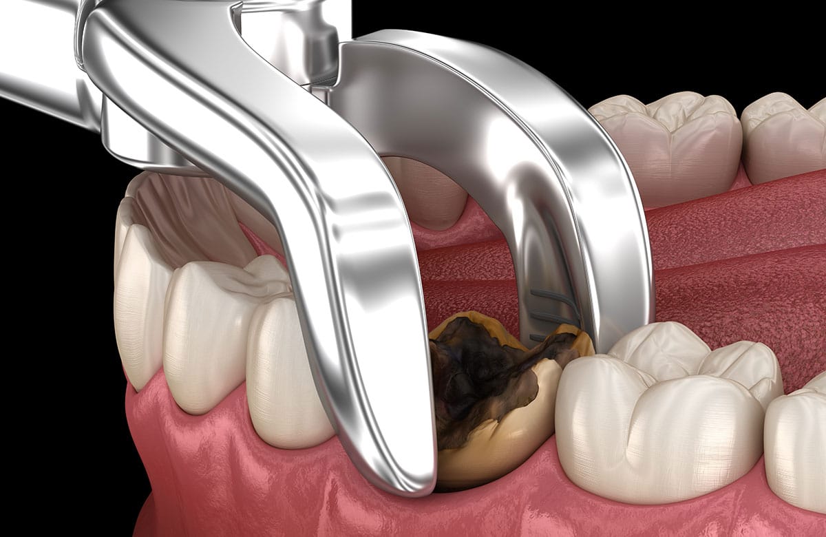 Wisdom Tooth Removal / Extraction_0