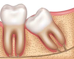 Impacted Wisdom Tooth_0