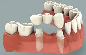 Tooth Replacement (Consult first)_0