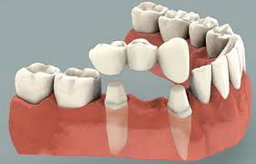 Tooth Replacement (Consult first)