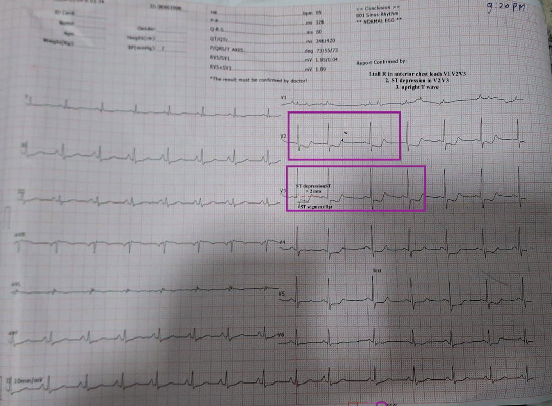 ECG
