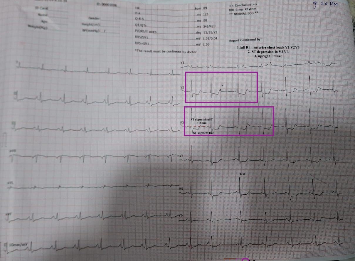 ECG_0