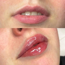 Técnicas en Labios