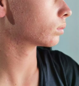 Acne  CREAM