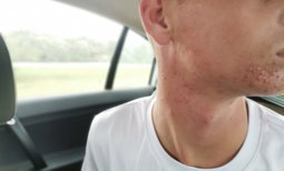 Acne  CREAM