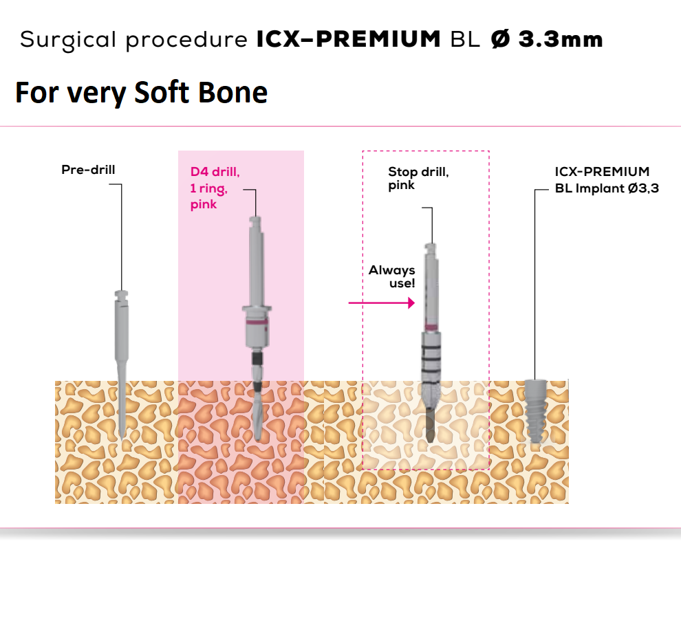 ICX Premium Bone Level IMPLANT Ø3.3_8