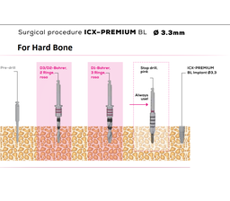 ICX Premium Bone Level IMPLANT Ø3.3