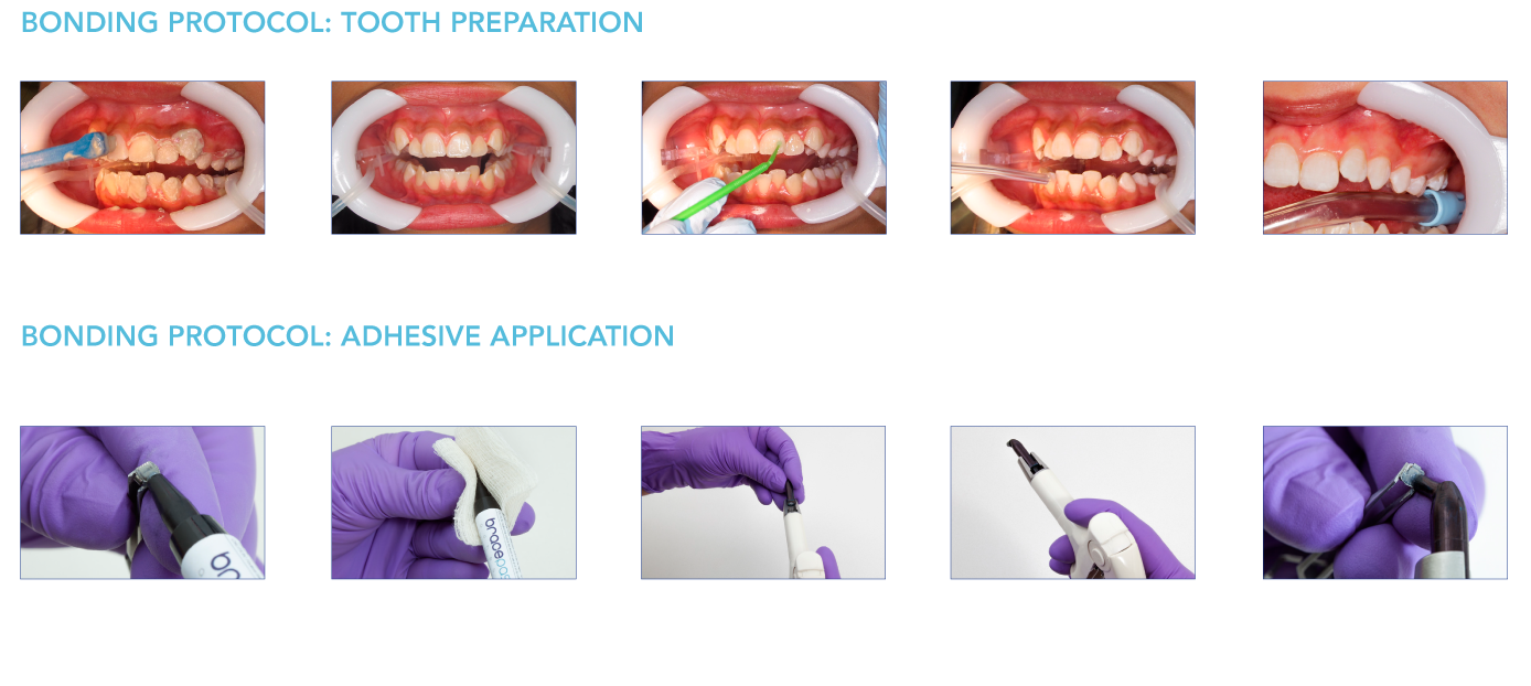 ADHESIVE BRACEPASTE KIT WITH MTP _3