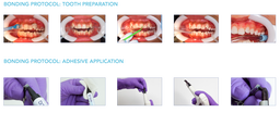 ADHESIVE BRACEPASTE KIT WITH MTP 