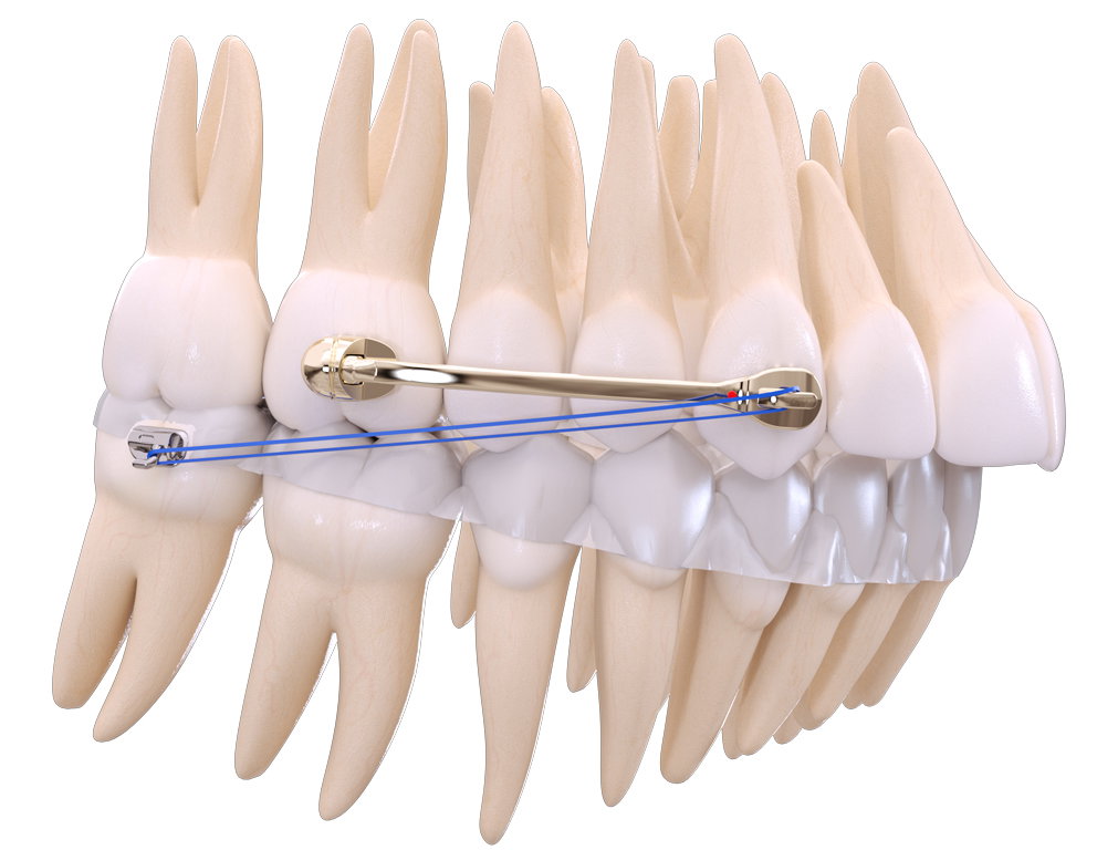 POWER BAR CLASS II CORRECTOR _3