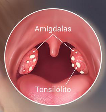 Kit Removedor de Tonsilolitos _3