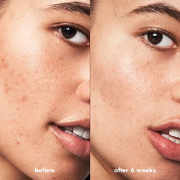 Blemish Breakthrough Acne Spot Gel