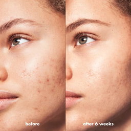 Blemish Breakthrough Acne Spot Gel