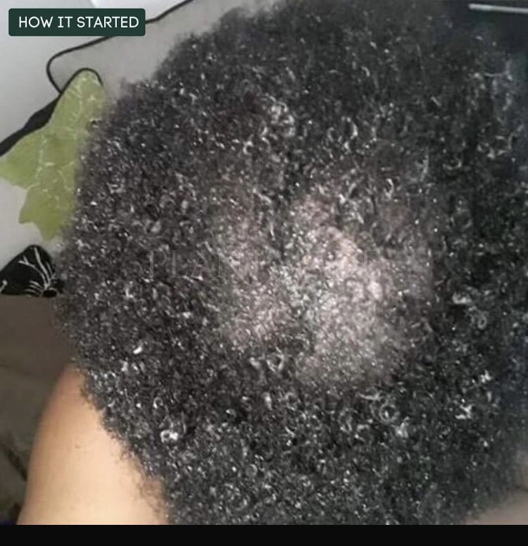 Hair growth and Antidandruff Combo_1