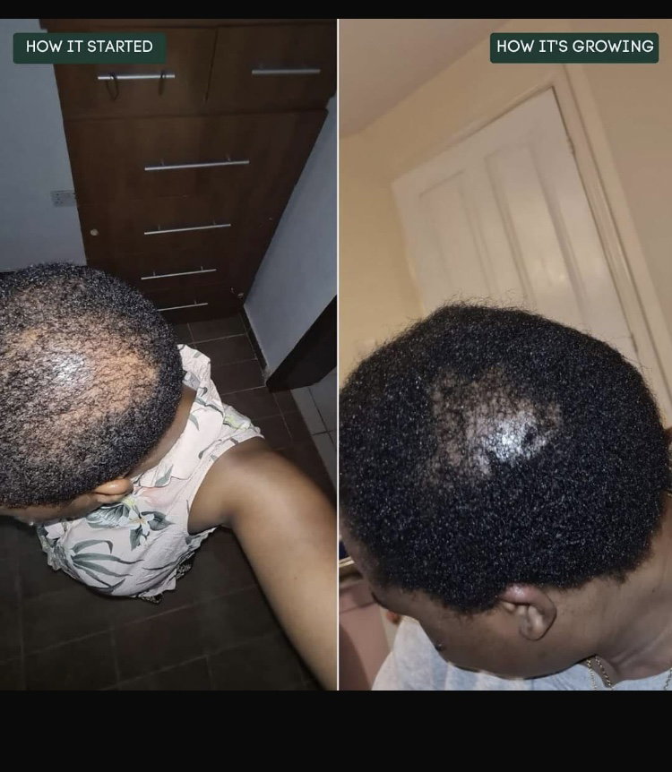 Hair growth and Antidandruff Combo_2