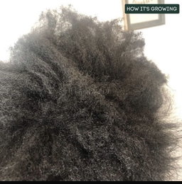 Hair growth and Antidandruff Combo