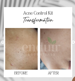 Acne Control Face Wash (Aloe & Moringa)