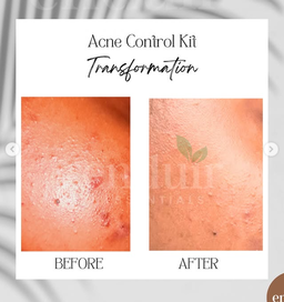 Acne Control Face Wash (Aloe & Moringa)