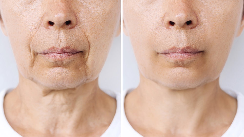 Base en Crema, Borrador de Lineas de Expresion. _1