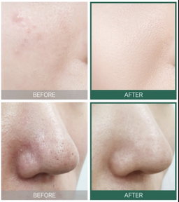 SOMEBYMI AHA.BHA.PHA 30 Days Miracle Starter Kit