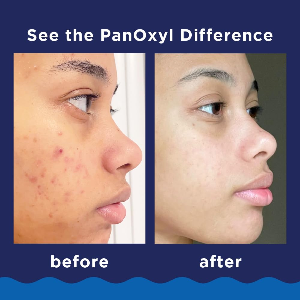 PanOxyl Acne Wash 10% Benzoyl Peroxide_2