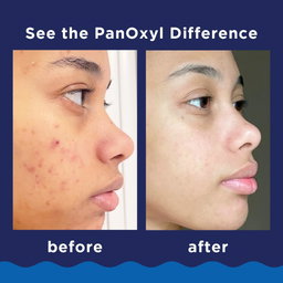PanOxyl Acne Wash 10% Benzoyl Peroxide
