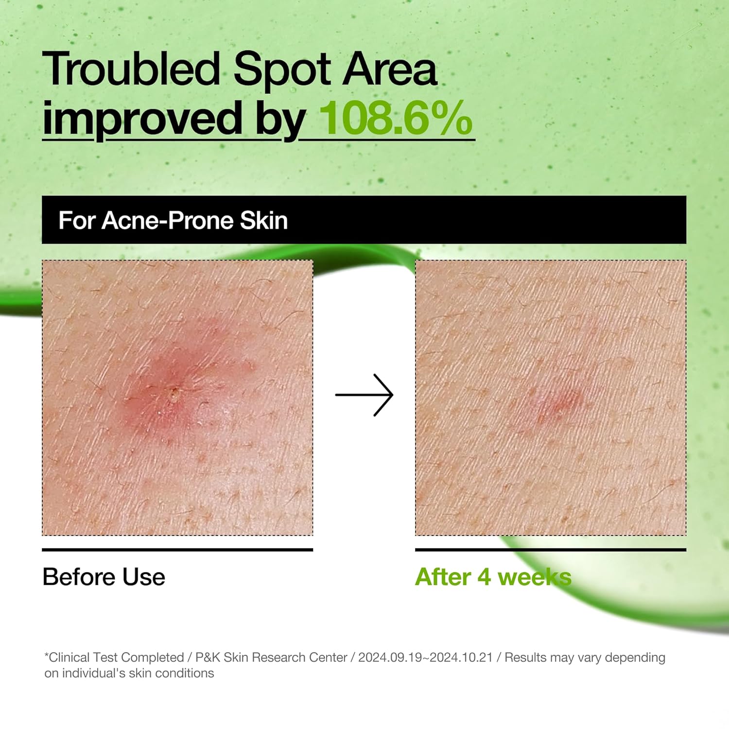 Anua Azelaic Acid 10 Hyaluron Redness Soothing Serum_4