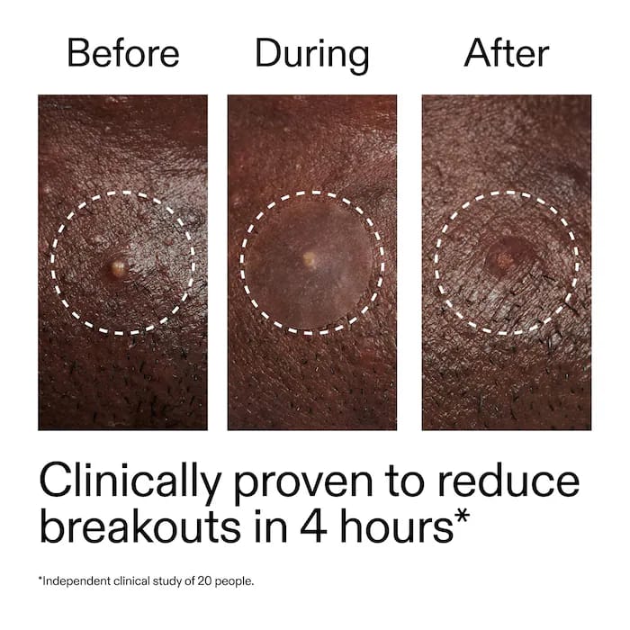 The Inkey List - Hydrocolloid Invisible Pimple Patches_4