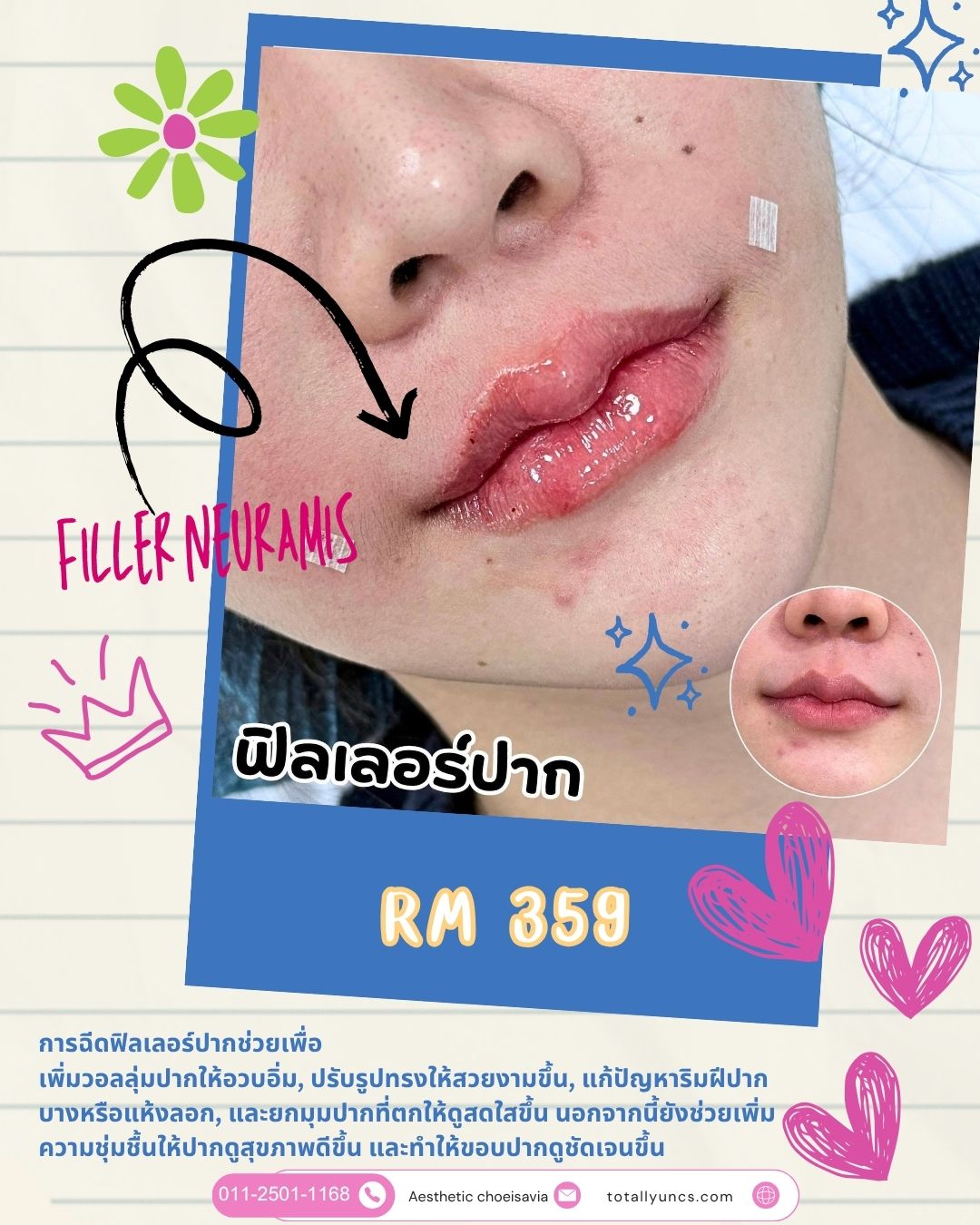 Review 🩷💉👄
