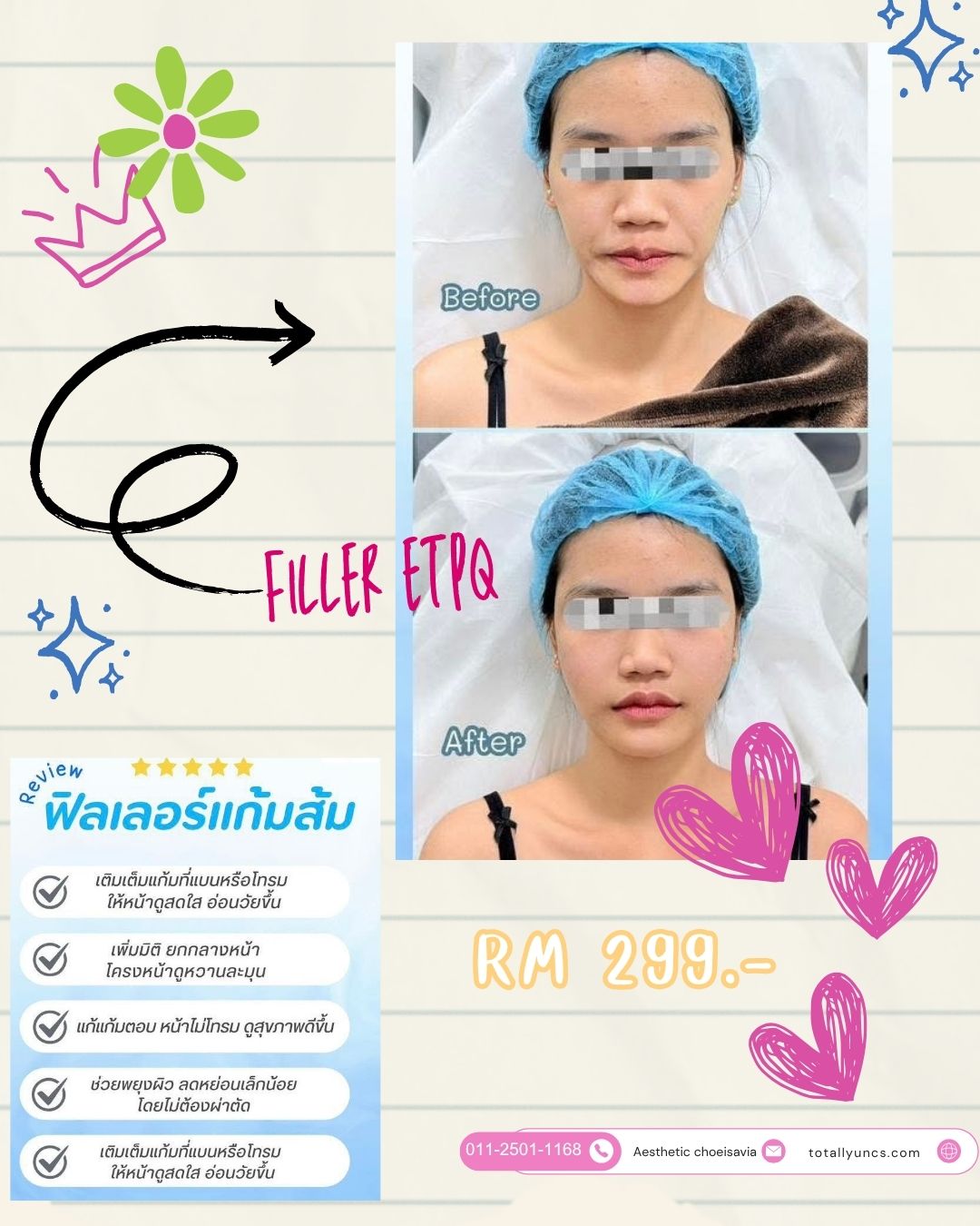 Review 🩷💉Filler แก้มส้ม ทำให้ดูเด็ก ละมุนอ่อนเยาว์👶🏻_0