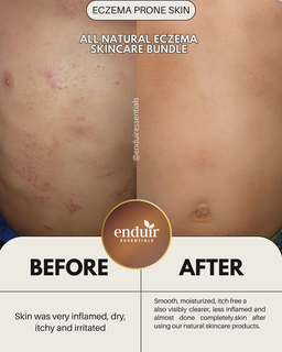 Eczema Relief Bundle 