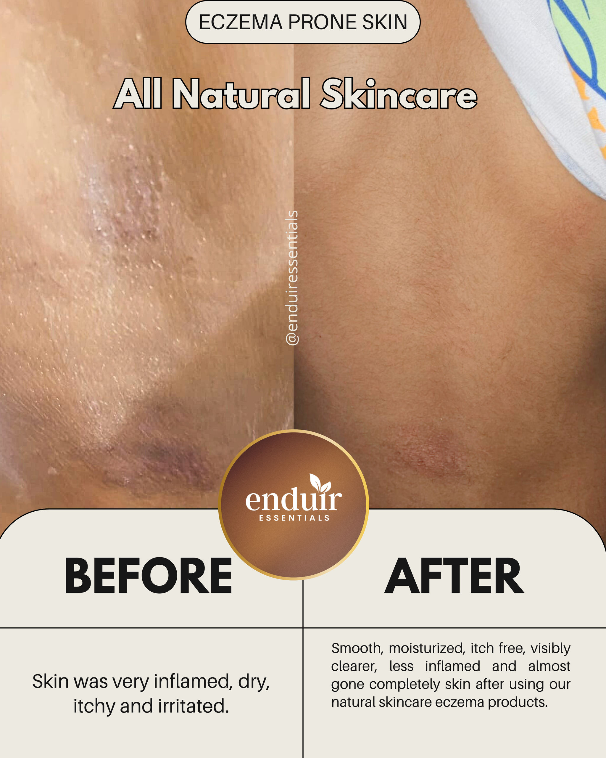 Eczema Relief Bundle _3