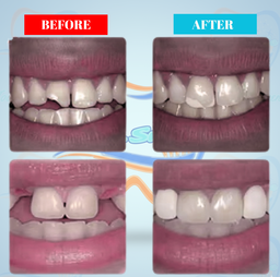 Dr. Smile Tooth Replacement Kit™