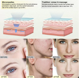 Face Lift & Pigment Removal Pen Needles
