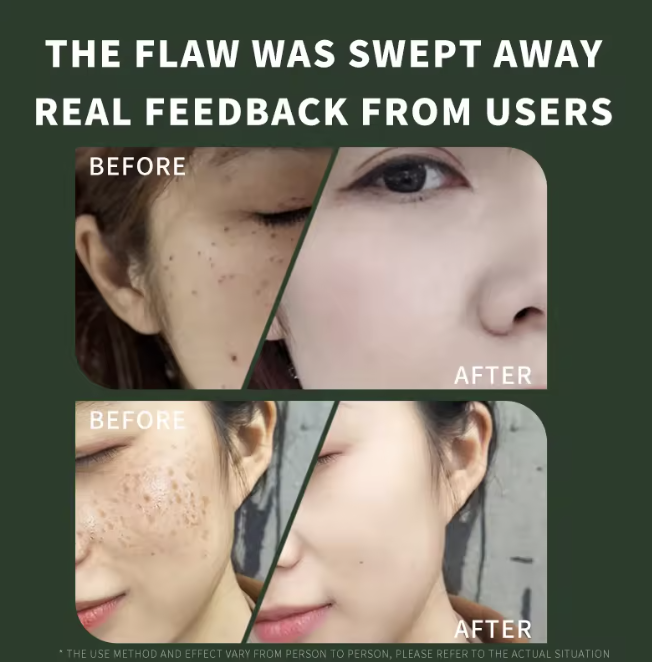 Skin Tag Remover *Professional Use*_1