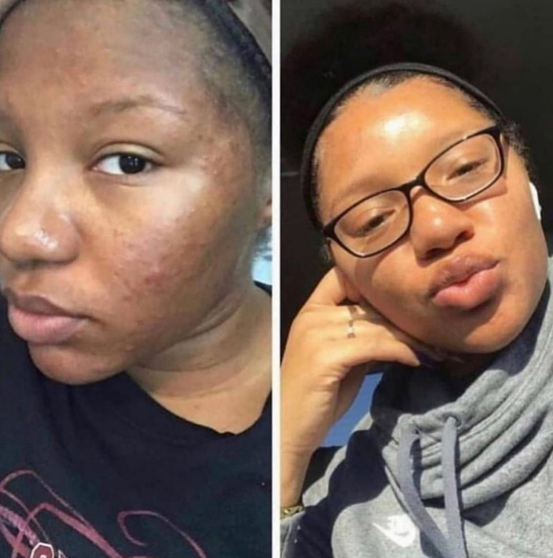 PIMPLES/ANCE SPOT REMOVAL COMPLETE SET_1