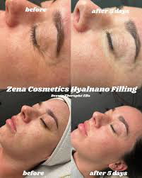 Zena Hyalnano Filling 2 vial set
