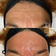 Zena Hyalnano Filling 2 vial set_2