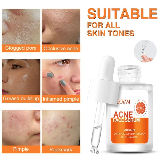 MOOYAM 30ml Facial Serum for Acne, Pimples, Blemishes & Oily Skin_1