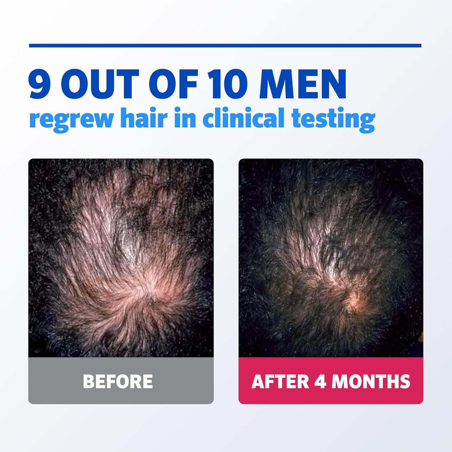 Rogaine -  5% Minoxidil for Men & Women Foam_3