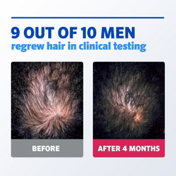 Rogaine -  5% Minoxidil for Men & Women Foam