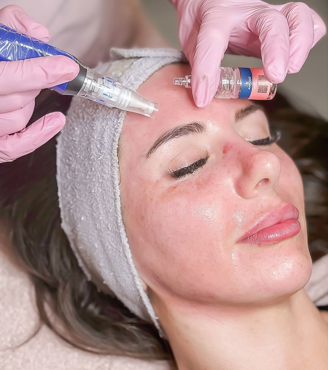 Microneedling (based on facial concern)